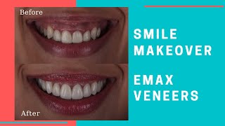 Emax Veneer Smile Makeover  Dental Excellence Turkey  Patient Experience [upl. by Yuk]