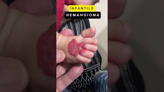 Infantile Hemangioma hemangioma infants treatment [upl. by Egarton]