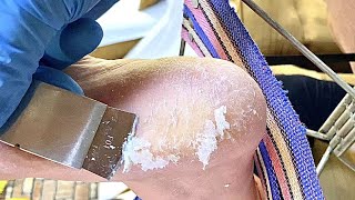 Callus removal from feetampFoot scraping dead skin【DT pedicure】stress 5 [upl. by Otsenre]