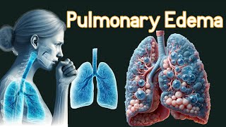 Pulmonary Edema Fluid In the Lungs Symptoms amp causes [upl. by Einnoj]