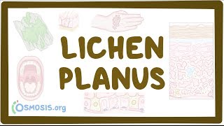 Lichen planus  causes symptoms diagnosis treatment pathology [upl. by Cozmo]