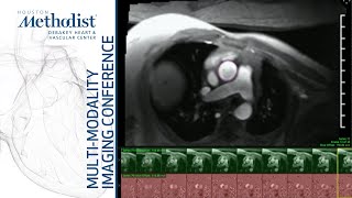 Mitral and Aortic Regurgitation Evaluation by Echo amp CMR Faza MD amp ElTallawi MD November 2 2021 [upl. by Elletnohs251]