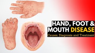 What Is Hand Foot amp Mouth Disease HFMD  KK Womens and Childrens Hospital [upl. by Natalee]