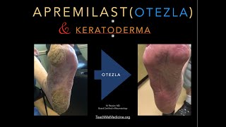 Apremilast Otezla and Keratoderma [upl. by Cleti426]