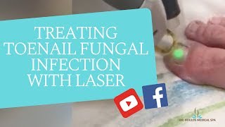 Treating Toenail Fungal Infection With Laser [upl. by Reisfield45]