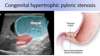 Pyloric stenosis step by step pylorus ultrasound Pyloric hypertrophic [upl. by Alfonse]