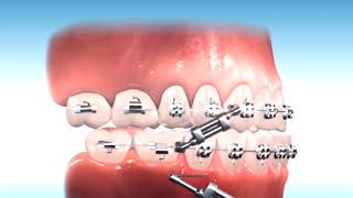 How to correct Class III Malocclusion [upl. by Arlen]