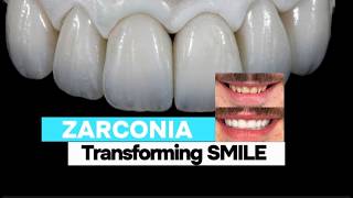 Zirconia before and after crowns Finally Revealed  zirconia teeth before and after  la dentist [upl. by Calva]