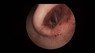 septal mucositis [upl. by Oiliruam]