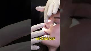 Rinoplastia Increíble cambio [upl. by Notyard]