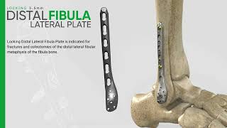 Zimed  Locking Distal Lateral Fibula Plate [upl. by Ennaesor]