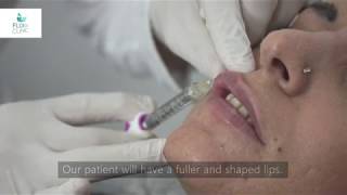 How to do Lip Fillers  Flora Clinic Istanbul 2019 [upl. by Schreibe]