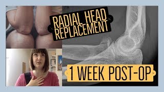 Radial head replacement surgery 1 week postop [upl. by Keverne]