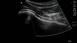 Ultrasound Hip Joint Injection  Nashville Hip Institute [upl. by Notnats]