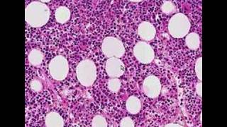 Histopathology Bone marrow Follicular lymphoma [upl. by Naruq]