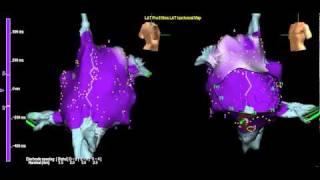 Clockwise right atrial flutter with anisotropy at Crista Terminalis [upl. by Binni]