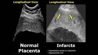 Placenta Ultrasound Normal Vs Abnormal Image Appearances Comparison  Placental Pathologies on USG [upl. by Anelrad899]