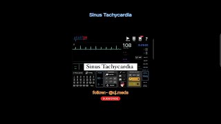 Sinus Tachycardia  what to do  Cardioversion [upl. by Emoraj]