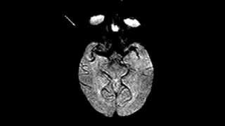 Normal brain perfusion [upl. by Rahman]