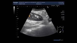 Ultrasound Video showing an Ectopic Kidney with a renal and ureteral stone [upl. by Alfonse124]