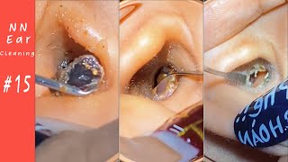 Impacted Ear Wax RemovalEP15  NN Ear cleaning [upl. by Eimmas]