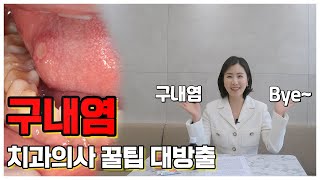 하루 종일 신경 쓰이는 구내염 원인과 빨리 낫는 법feat알보칠 안 아프게 바르는 꿀팁 [upl. by Butch917]