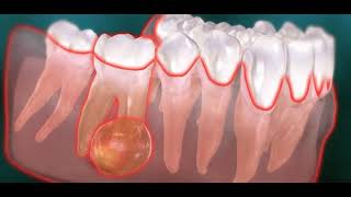 Abcès endodontique dentaire kyste [upl. by Eihpos]