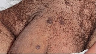 HPV em homens Conheça os sintomas causas prevenção tratamento [upl. by Cordula]