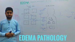 EdemaOedemaEdema pathologyintroduction to edema [upl. by Rese]