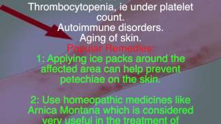 What are petechiae Remedies for petechiae [upl. by Eisse286]