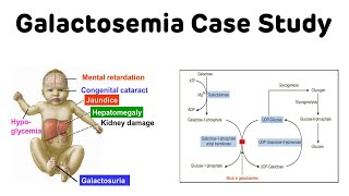 Galactosemia Case Study  Classical Galactosemia  NEXT PG Biochemistry [upl. by Llert34]