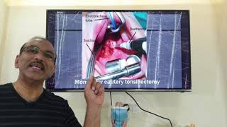 Techniques of tonsillectomy  HINDI Patient teaching programme [upl. by Bigg899]