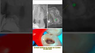 Segundo molar superior con fusión radicular entre MV y P istmo y 5 conductos [upl. by Anoyi]