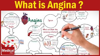 Pharmacology CVS 16 What is Angina Pectoris  Types of Angina Symptoms Causes and Treatment [upl. by Hun300]