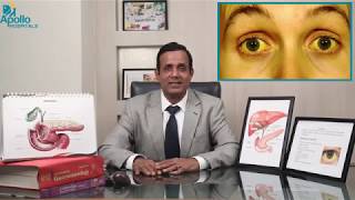 Jaundice Pilia in Hindi by Dr Shravan Bohra Liver Specialist Apollo Hospitals Ahmedabad [upl. by Janith]