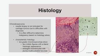 Chondrosarcoma [upl. by Hsihsa]