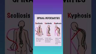 spinal deformities scoliosis lordosis kyphosis plzsubscribemychannel 100subscribersfast [upl. by Michal]