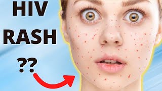 HIV Rash on Face  How to Identify an HIV Rash [upl. by Frohne23]