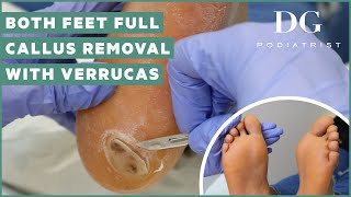 Callus removal from feet both feet and three verruca plantar warts treatment [upl. by Wendy843]