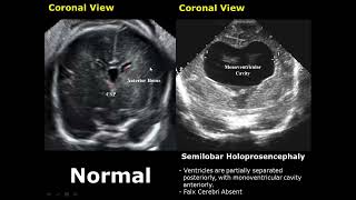 Fetal Brain Ultrasound Normal Vs Abnormal Image Appearances Comparison  Fetal Brain Pathologies USG [upl. by Nuahsed]