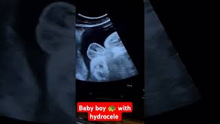 Baby boy ultrasound with hydrocele [upl. by Notnarb]