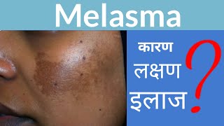 melasma treatment  झाइयों का कारण और इलाज  सेहुआ का गजब इलाज  Dr Remedy Root [upl. by Ashwin]