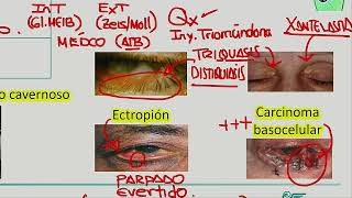 Blefaritis conjuntivitis [upl. by Tamarra]