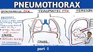 Pneumothorax pathophysiology in Hindi  part1 [upl. by Aizahs144]