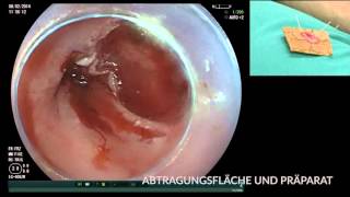 Karzinom im Barrett Ösophagus EMR und RFA [upl. by Alenas]