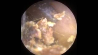 Ear Hook Ear Wax Removal using Otoendoscope  Mr Neel Raithatha The Hear Clinic [upl. by Tomasz289]