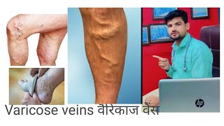 quotHomeopathic medicine and treatment for varicose veins वैरिकाज़ वेंस – explainedquot [upl. by Claudy301]