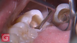 HOW TO Clean Up Severe Occlusal Decay on TOOTH 31 1 of 2 [upl. by Nairda]