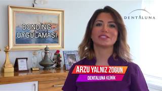 quot Bonding Uygulaması Yaptıranlar quot quot Bonding Dolgu Fiyatları quot quot Diş Bonding quot [upl. by Sheela]