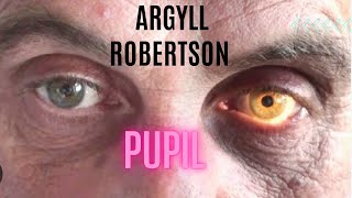 Argyll Robertson Pupil [upl. by Ynnavoig]